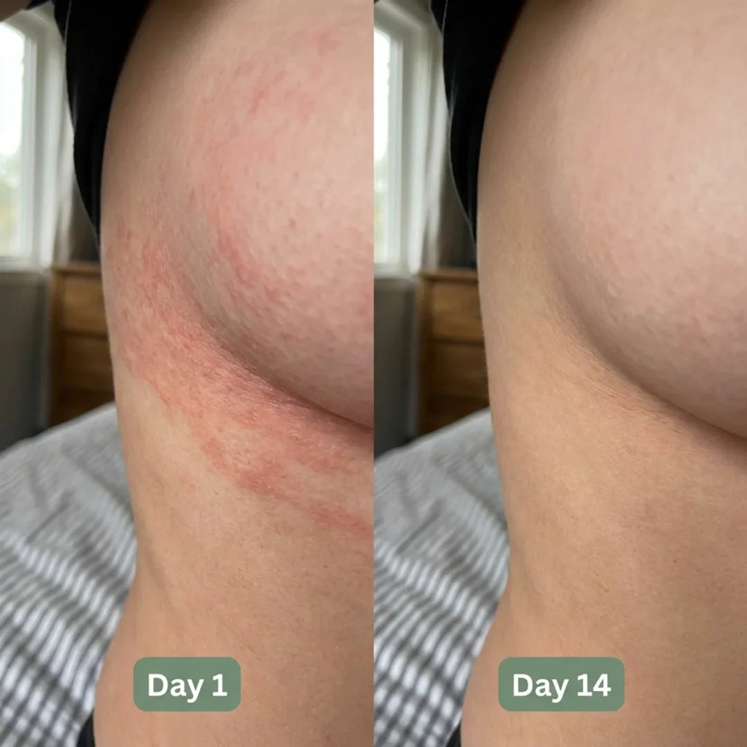 Intertrigo Relief Cream